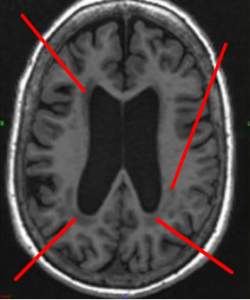 qu'est ce qu'une leucopathie vasculaire - leucopathie vasculaire ce n'est rien