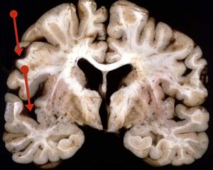 Brain atrophy - Neuromedia